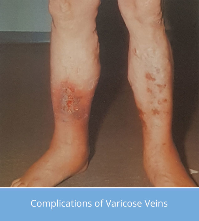 complications-of-varicose-veins-