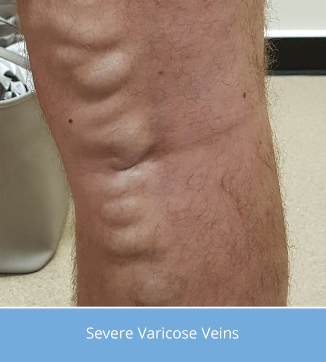 severe-varicose-veins