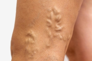 Are varicose veins dangerous?
