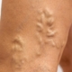 Are varicose veins dangerous?