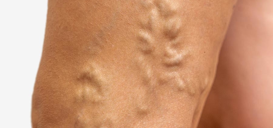Are varicose veins dangerous?